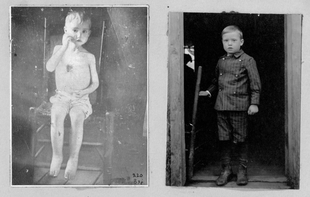 A side-by-side image of a young boy with a disease called hookworm and one after he's recovered